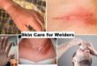 Skin Care for Welders