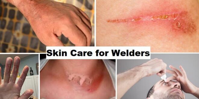 Skin Care for Welders